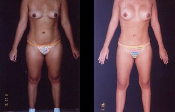 Liposucción de Abdomen espalda, cintura-cadera,piernas y brazos + Aumento de Senos por detrás del músculo con implantes de Perfil natural +
