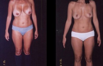 Retirada de implantes + Levantamiento de senos + Liposucción de cintura-cadera y abdomen.