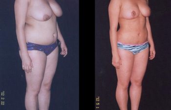 Reducción de Senos + Liposucción de Abdomen-cintura-cadera y espalda.