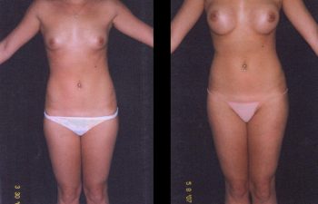 Aumento de senos simple. Implante en posición retroglandular con descenso del surco submamario. Paciente de torso largo y estatura mediana. Senos Copa B