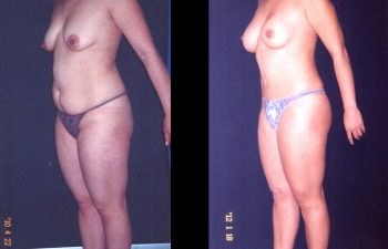 Liposucción + Aumento de senos + Abdominoplastia + Reducción de areola. Implante en posición retroglandular sin descenso del surco. Paciente de torso largo. Senos Copa B