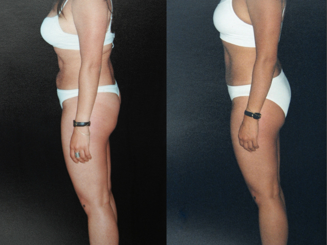 Corrección Liposucción abdominal – Resultado a los 10 meses. Vista lateral izquierda