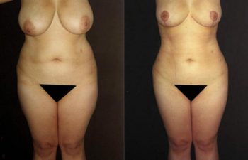 Mamoplastia de reducción mas liposucción corporal, cicatriz en ancla, reducción de 600 gramos por mama.