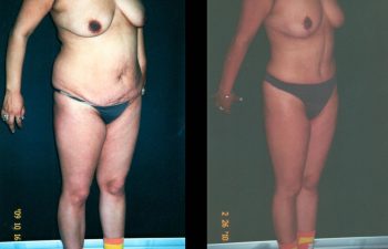 Liposucción de espalda-cintura y caderas + Abdominoplastia + Levantamiento de Senos. Resultado al año.