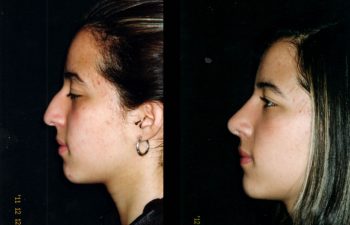 Rinoplastia de Aumento y reducción en su dorso nasal. Fueron necesarios injertos separadores. Punta Nasal Proyectada y definida. Resultado a los 7 meses.