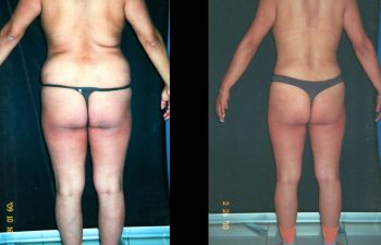 Abdominoplastia + Levantamiento de Senos + liposucción de espalda-cintura y caderas. Resultado al año.