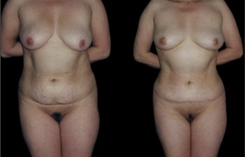 Liposucción de torso completo y abdominoplastia.