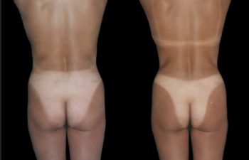 Liposucción de cintura, abdomen superior e inferior.