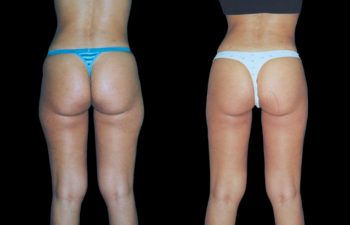 Liposucción de cintura, cadera, "conejos" glúteas y contorno de piernas. Nótese en la foto de la derecha, piel intacta sin manchas, depresiones, ni irregularidades.