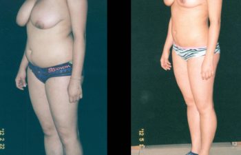 Reducción de Senos + Liposucción de abdomen-espalda-cintura-caderas. Resultado a los 3 meses.