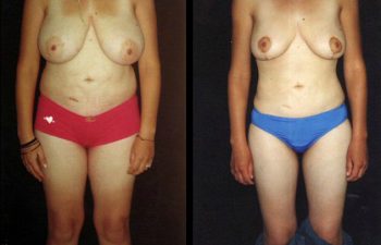 Liposucción de cadera y cintura + Reducción de senos, cicatriz en ancla.