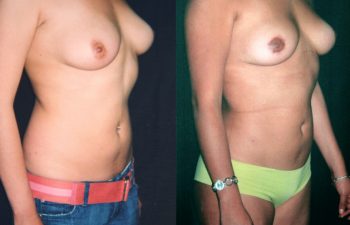 Vista derecha, obsérvese la ausencia de cicatriz y reducción de 90 gramos, en mama derecha, resultados a los 4 meses.