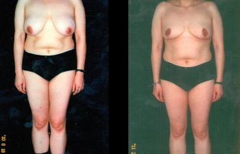 Mamoplastia de Reducción con cicatriz en Ancla. Se retiraron 250 gr de cada seno. Resultado a los 5 meses. Vista de Frente
