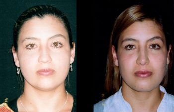 Rinoplastia, Mentoplastia más adelgazamiento de cachetes, Cirugía multiple de cara. Resultados a los 8 meses.