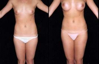 Liposucción de cintura + Mamoplastia de aumento, Nótese descenso del surco mamario.