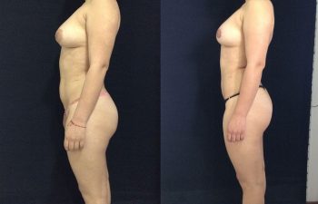 Liposucción de cintura, cadera, conejos, abdomen + Pexia Periareolar. Resultado a los 2 meses.