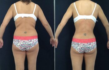 Liposucción de espalda + cintura + cadera + abdomen + piernas Resultado a los 3 meses de cirugía