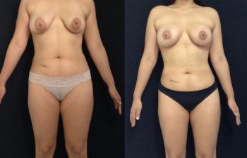 Cirugía Múltiple de cuerpo + Mamoplastia de Aumento + levantamiento periareolar sin cicatriz + Liposucción Resultado al mes y 27 días de cirugía