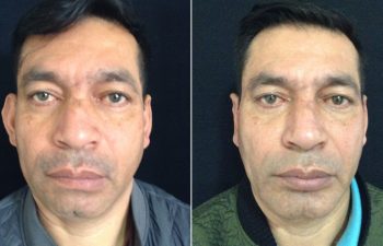 Rinoplastia + Mentoplastia + Cirugía Múltiple de cara Resultados a los 3 meses de cirugía
