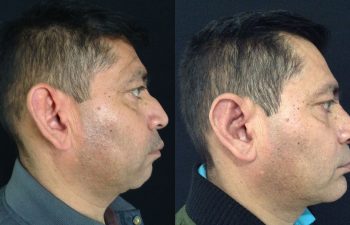Rinoplastia + Mentoplastia + Cirugía Múltiple de cara Resultados a los 3 meses de cirugía