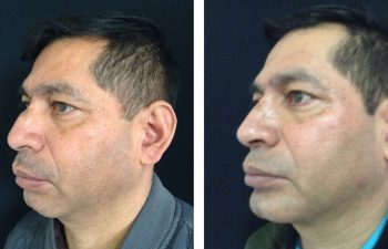 Cirugía Múltiple de cara + Rinoplastia + Mentoplastia Resultados a los 3 meses de cirugía