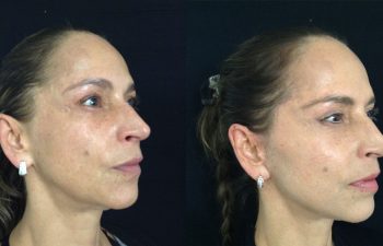 Rejuvenecimiento facial completo Resultado a los 4 meses de cirugía