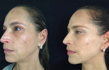 Rejuvenecimiento facial completo Resultado a los 4 meses de cirugía
