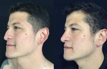 Rinoplastia de aumento + reducción de dorso y punta nasal Resultado a los 4 meses de cirugía
