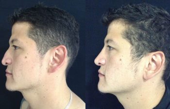 Rinoplastia de aumento + reducción de dorso y punta nasal Resultado a los 4 meses de cirugía