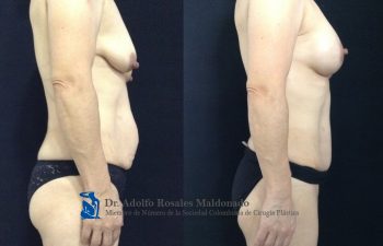 Liposucción de pliegue axilar posterior + espalda + cintura + cadera + Mamoplastia de aumento con levantamiento peri areolar + Abdominoplastia Resultados al año