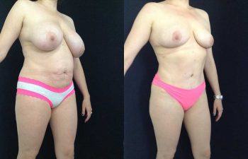 Cirugía múltiple del cuerpo: Mamoplastia de reducción + abdominoplastia resultado a los 5 meses de cirugía.