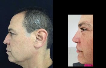 Aumento de radix + aumento dorso cartilaginoso + definición y proyección punta nasal resultado al año de cirugía.