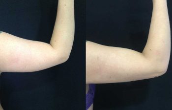 Liposucción de brazos resultados a los 8 meses de cirugía.