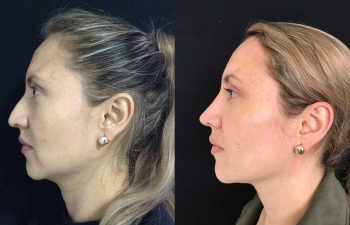 Disminución de dorso cartilaginoso + colocación de Spreader Graft + aumento de punta nasal + osteotomías resultado a los 9 meses y 10 días de cirugía.