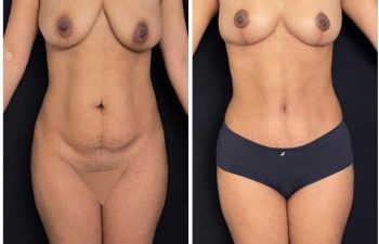 Abdominoplastia + liposucción + levantamiento de senos.