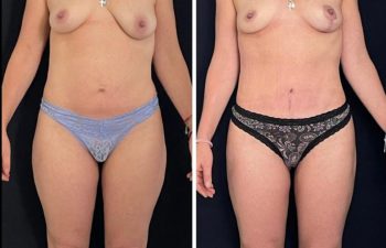 Abdominoplastia + liposucción + corrección de asimetría mamaria.