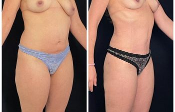 Abdominoplastia + liposucción + corrección de asimetría mamaria.