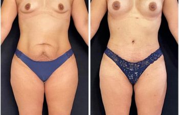 Abdominoplastia + liposucción + mamoplastia de aumento.