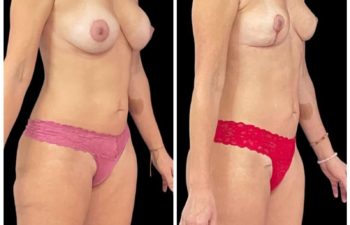 Explantacion mamaria + Reconstruccion con el propio seno + Lipoinyección. Resultado a los 2 meses.