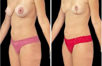 Explantacion mamaria + Reconstruccion con el propio seno + Lipoinyección. Resultado a los 2 meses.